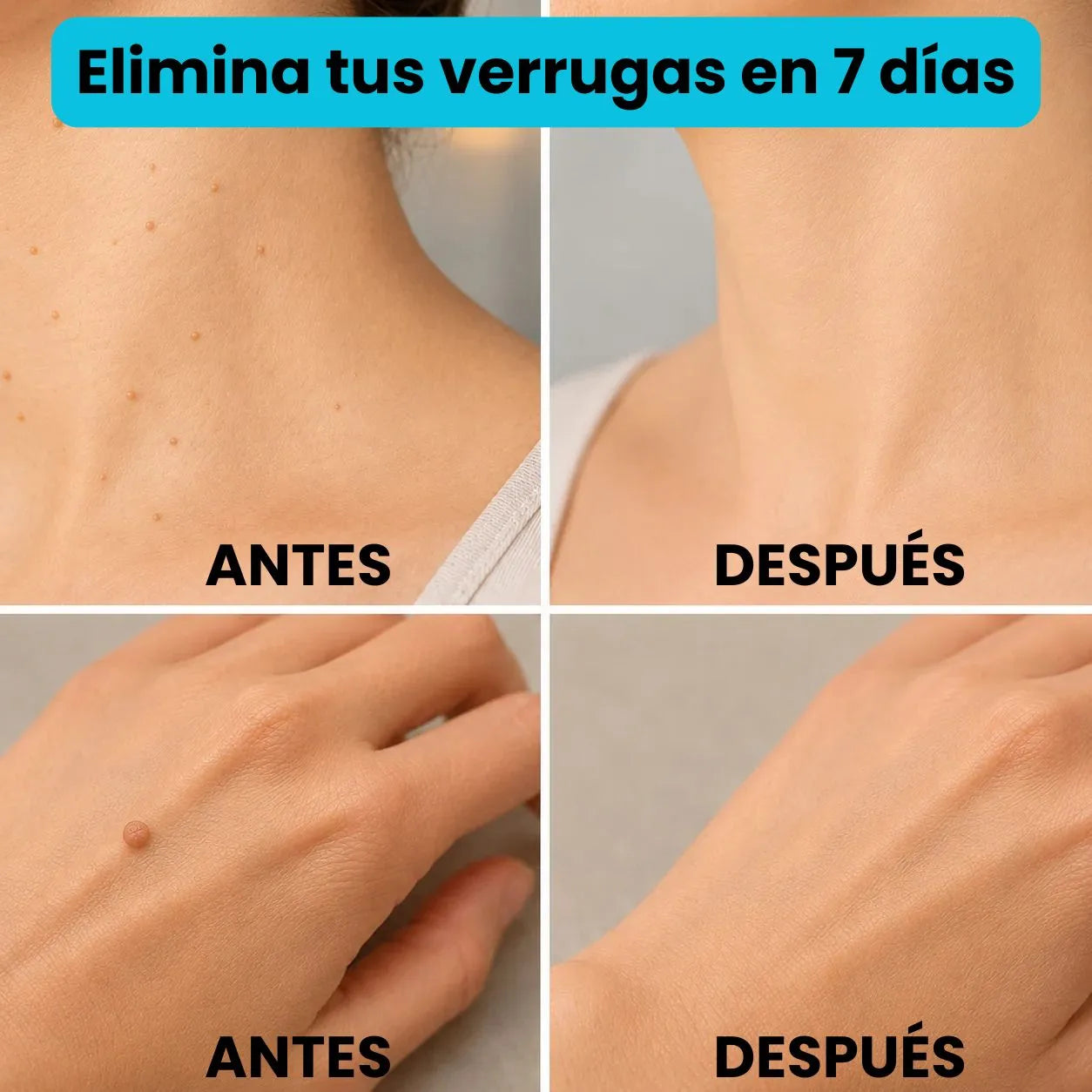Dermunex Clear® Crema ELIMINADORA de Verrugas en la piel